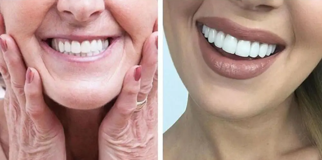 Montura Carillas dentales postizas