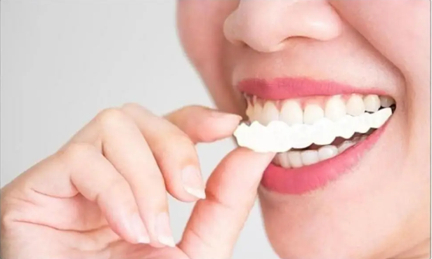 Montura Carillas dentales postizas